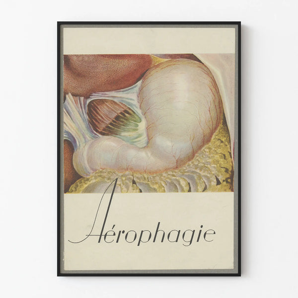 Vintage Medical Poster on Aerophagia with Anatomical Illustration
