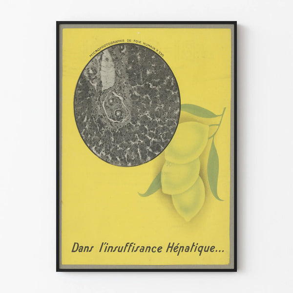 Vintage medical poster on liver failure