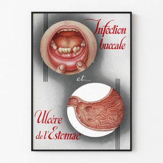 Vintage medical poster of oral infection and stomach ulcer