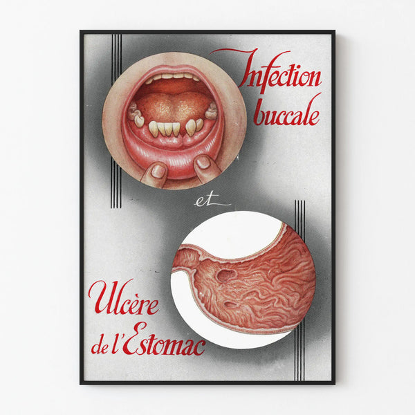 Vintage medical poster of oral infection and stomach ulcer